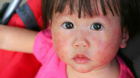 4 useful tips to treatment of atopic dermatitis in children