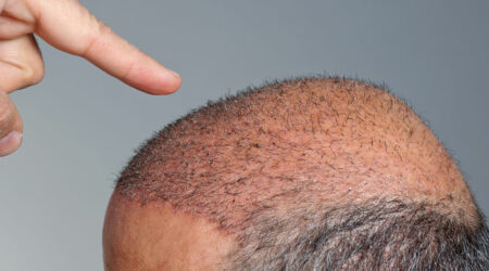 A guide to hair transplantation costs in Canada