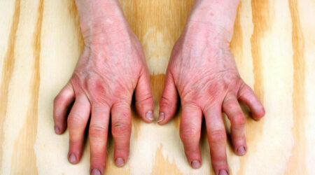 Do you have psoriatic arthritis symptoms