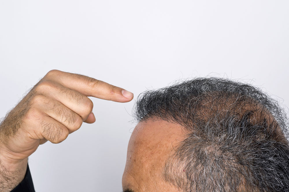 How much do hair transplants cost in the UK