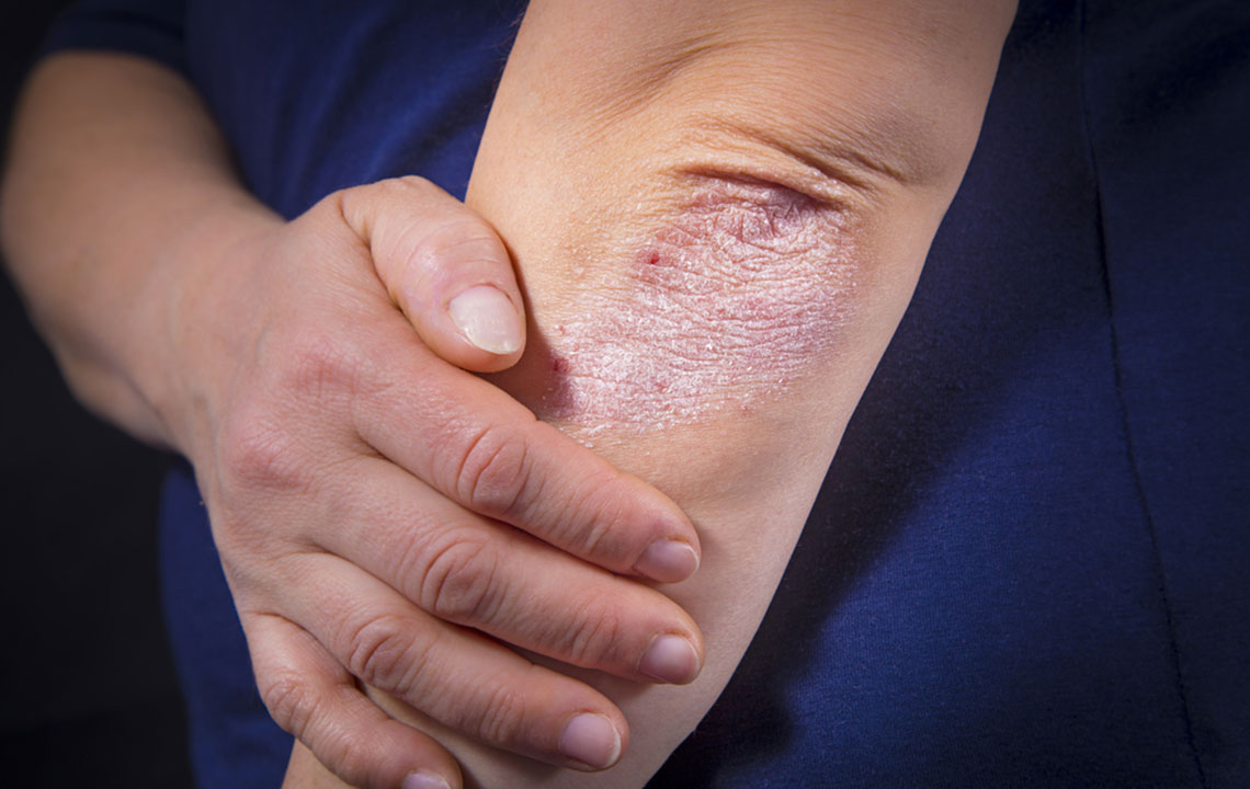 Symptoms and risk factors of psoriasis