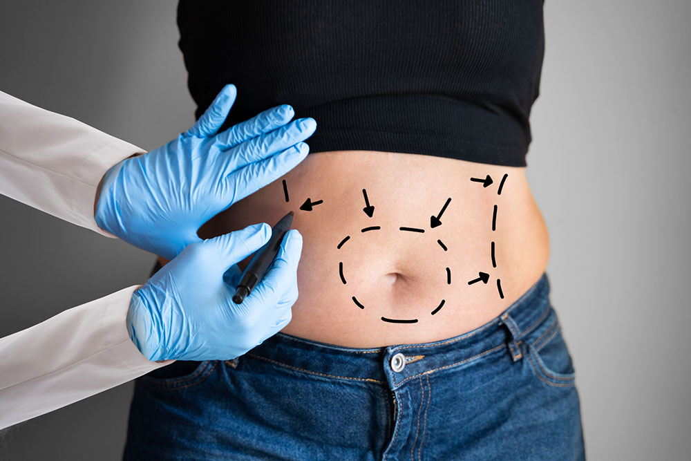 Abdominoplasty &#8211; Types, procedure, cost, and more