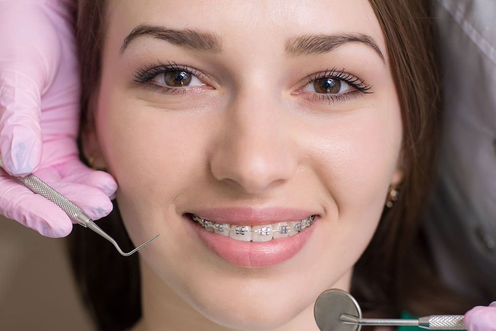 Dental braces &#8211; Types, procedure, and cost